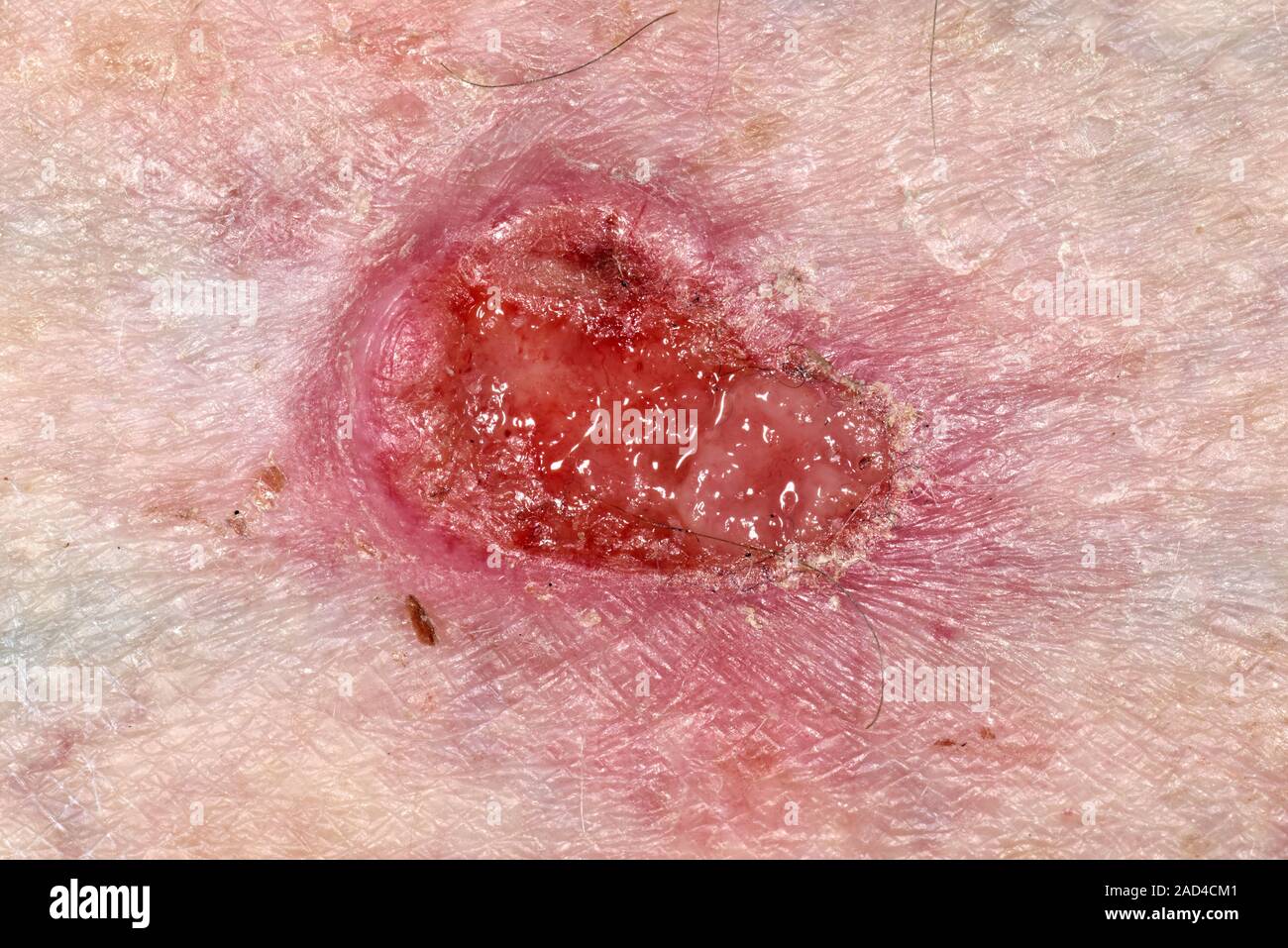 Basal cell carcinoma cancer de la peau. Closeup d'un ulcère basal
