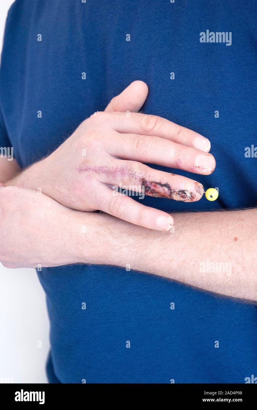 Fracture de doigt coincé. La fracture est à la phalange distale os à l