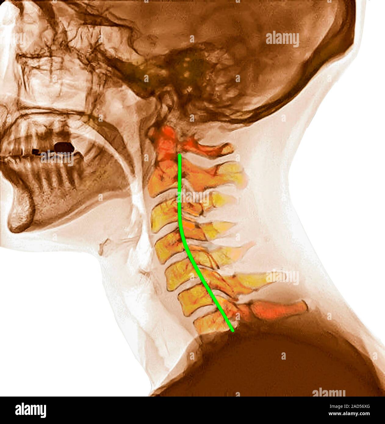 La courbure de la colonne cervicale. Radiographie latérale de couleur d