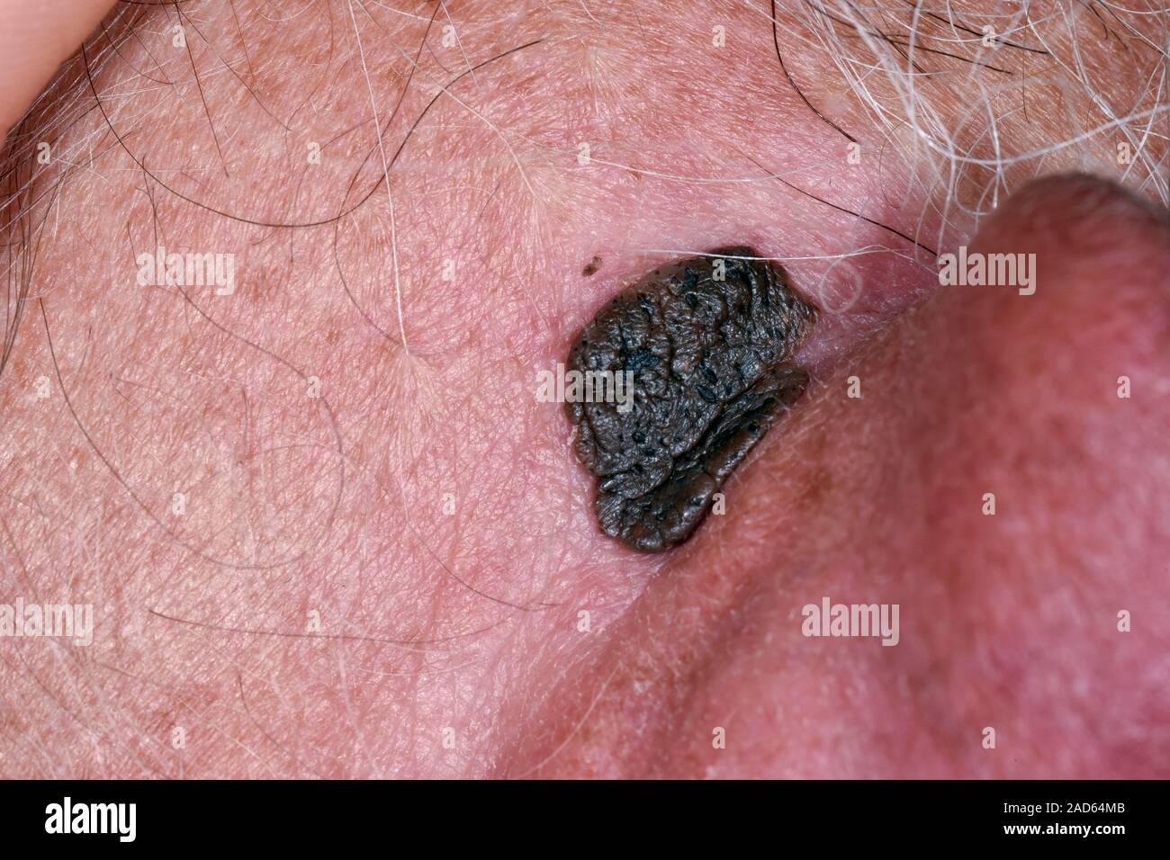 Kératose séborrhéique. Close-up d'une kératose séborrhéique (verrue sénile  ou séborrhéique) derrière l'oreille d'un 71-year-old male patient. Cette  croissance de peau est cau Photo Stock - Alamy