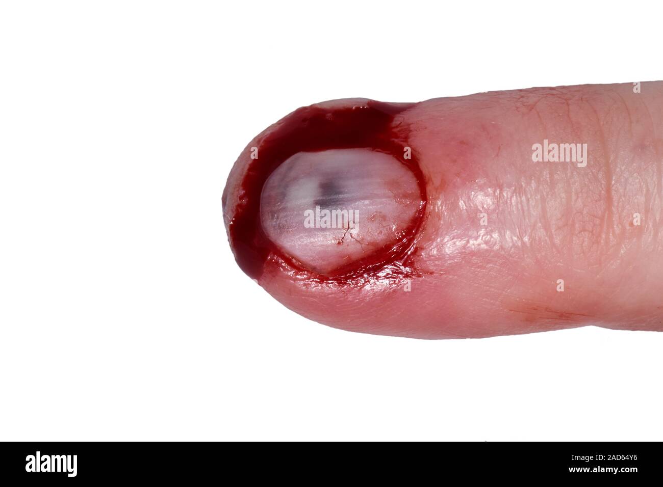 Blessures du doigt. Close-up de la sanglante d'un doigt lacérée 65 ans  patient qui coincé dans une porte. Ici, le sang a également recueilli und  Photo Stock - Alamy