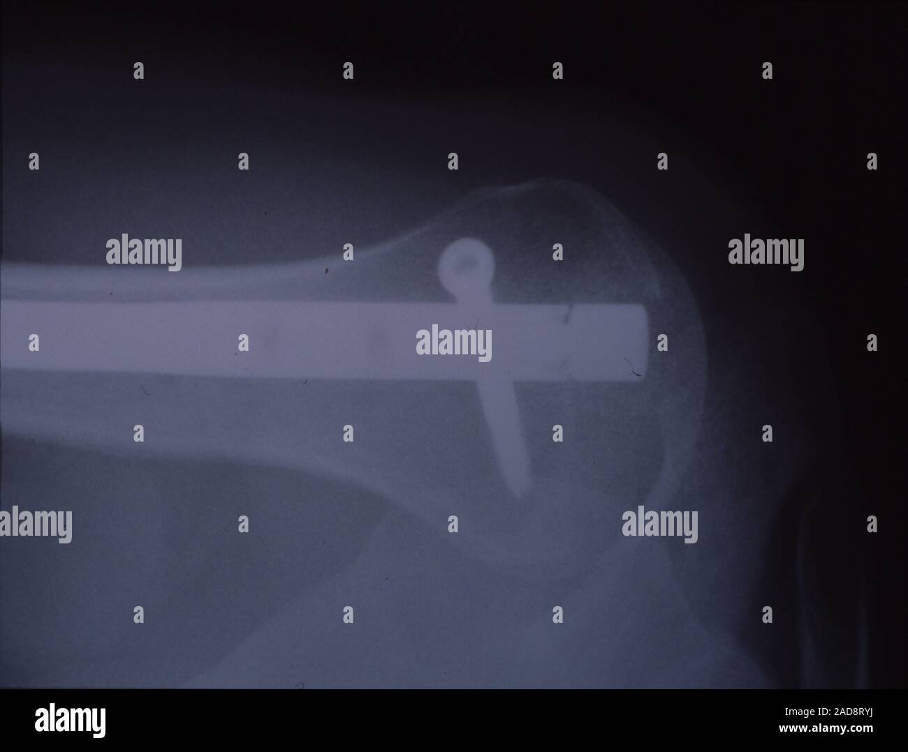 X-ray de bras avec rail métallique et la vis après l'accident de cheval Banque D'Images