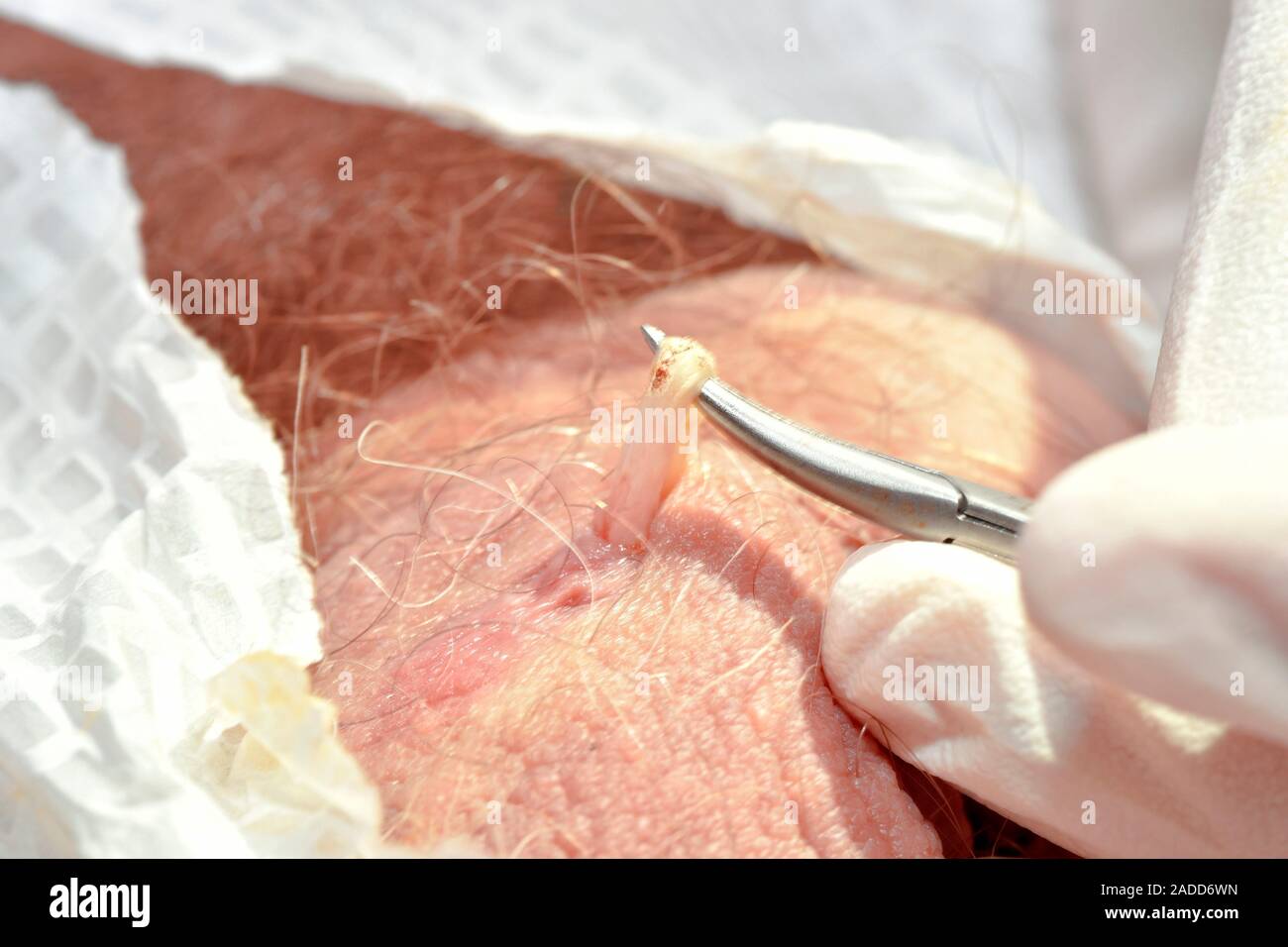 La chirurgie de la vasectomie. Canal déférent du patient d'être tirée à  travers le scrotum pendant la vasectomie ou stérilisation masculine  chirurgie. Les deux canaux déférents tha Photo Stock - Alamy
