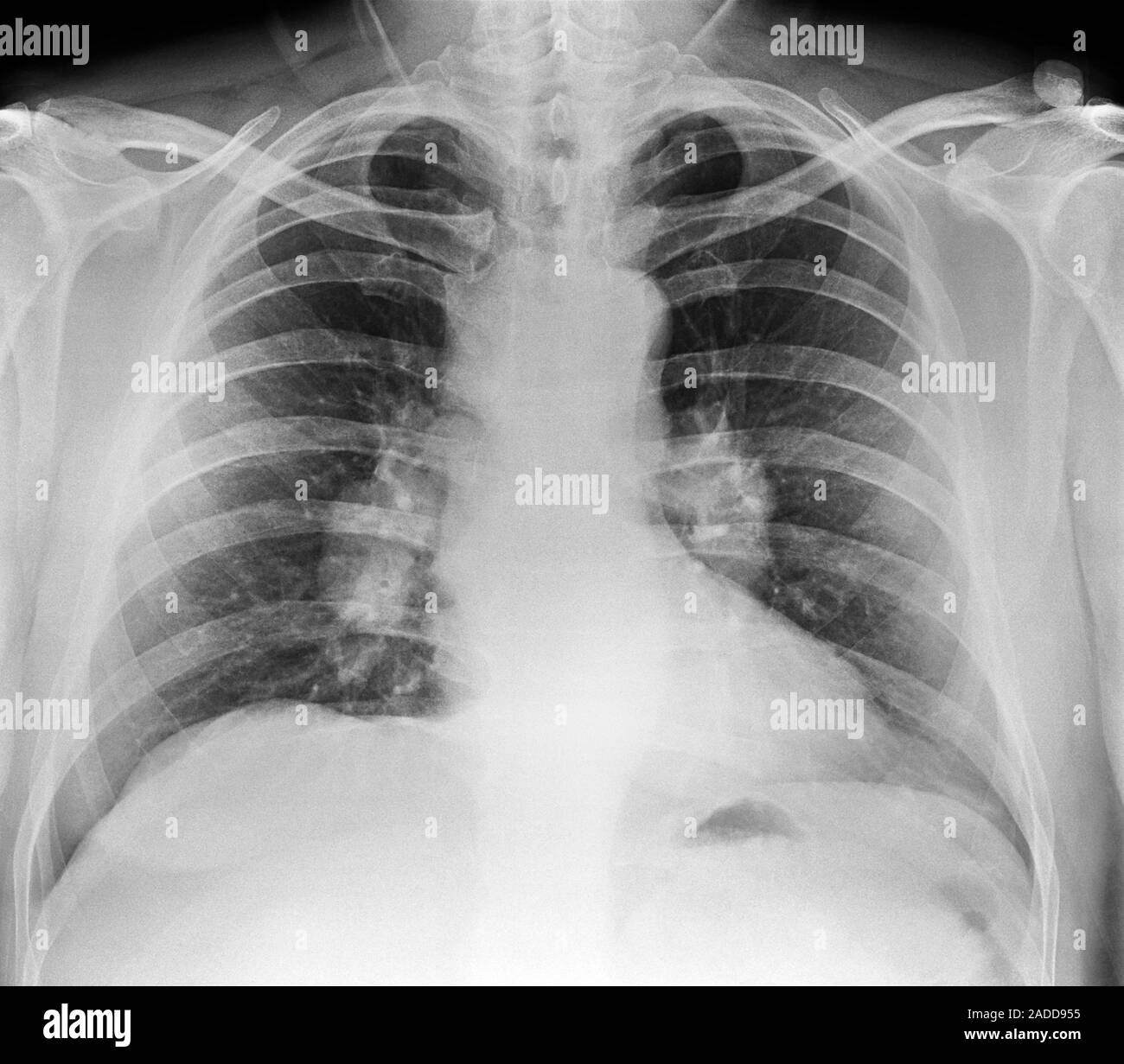 La sarcoïdose. Radiographie frontale des poumons d'un homme de 54 ans avec la sarcoïdose pulmonaire. Touché le tissu pulmonaire se manifeste par des taches opaques (à gauche un Banque D'Images