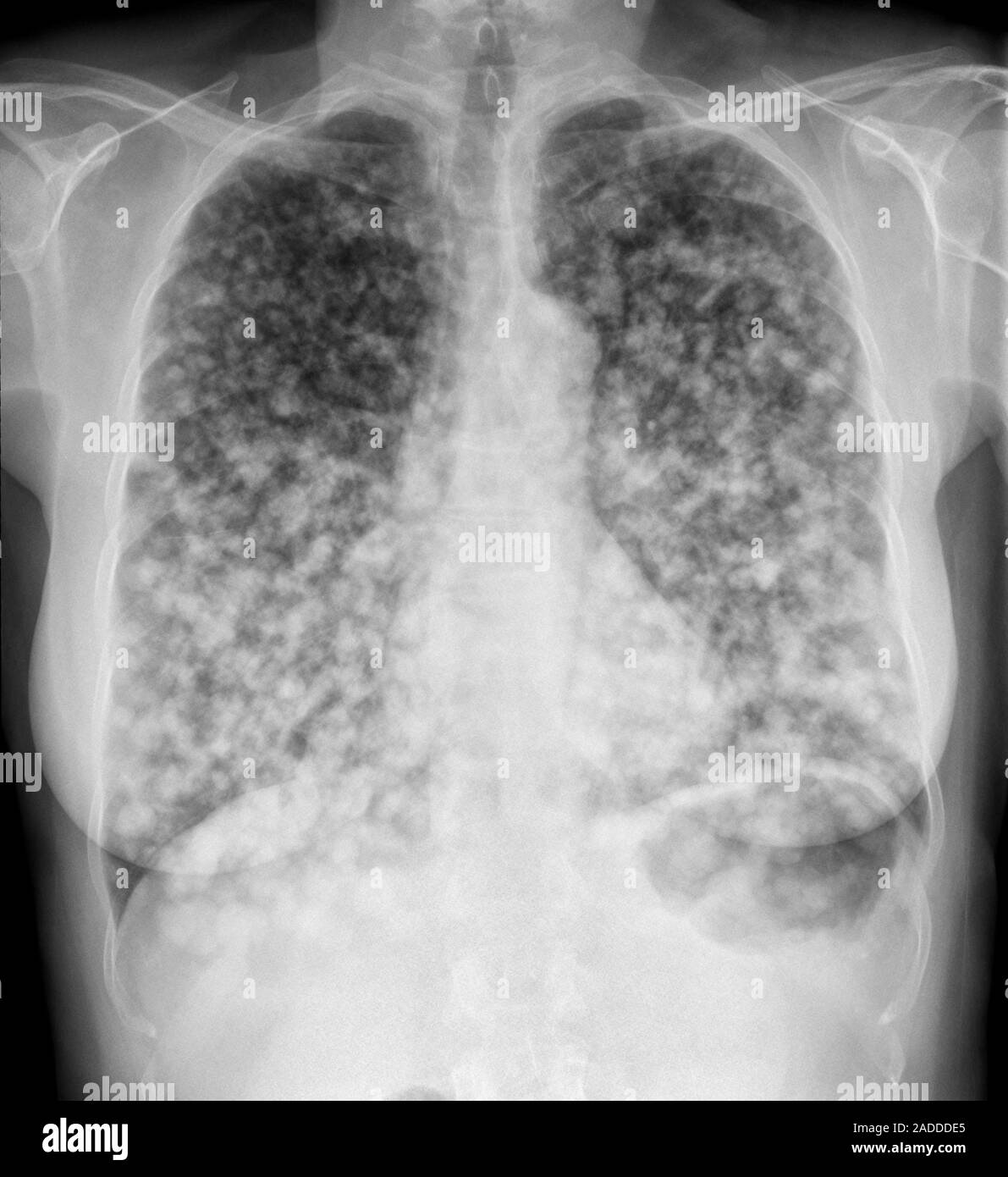 Le cancer du poumon secondaire. Radiographie d'une section par les poumons  (dark, gauche et droite) d'un patient atteint de plusieurs lesio tumeur  cancéreuse (maligne Photo Stock - Alamy