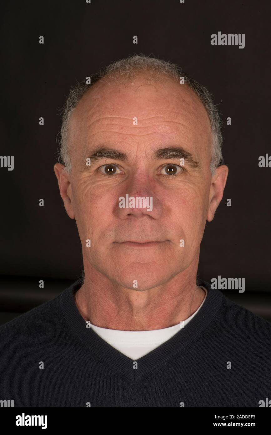 Fracture du nez après l'opération de rhinoplastie pour reconstruire le