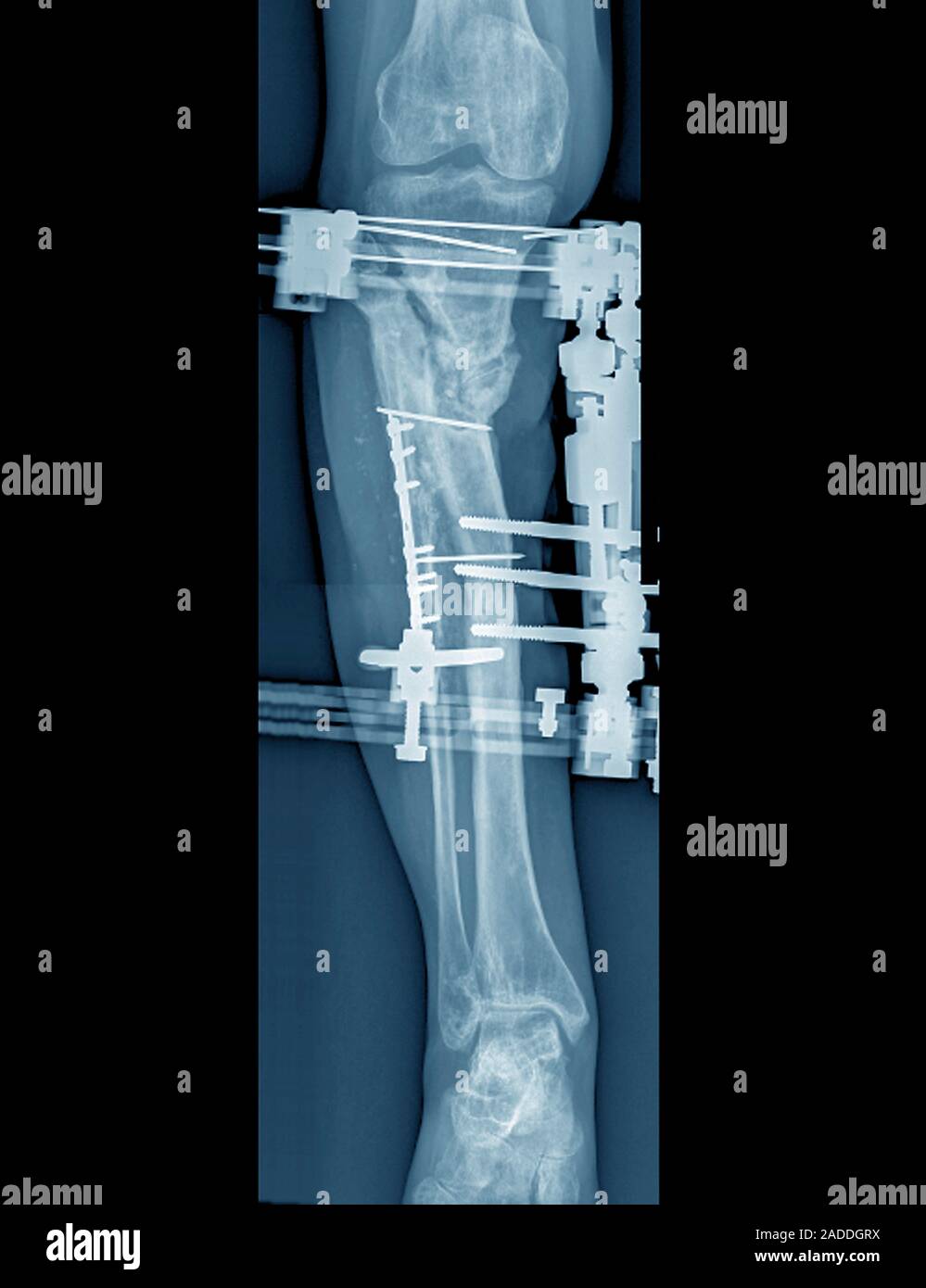 Les os de la jambe fracturée épinglé. Xray frontale de broches, vis et plaques (blanc