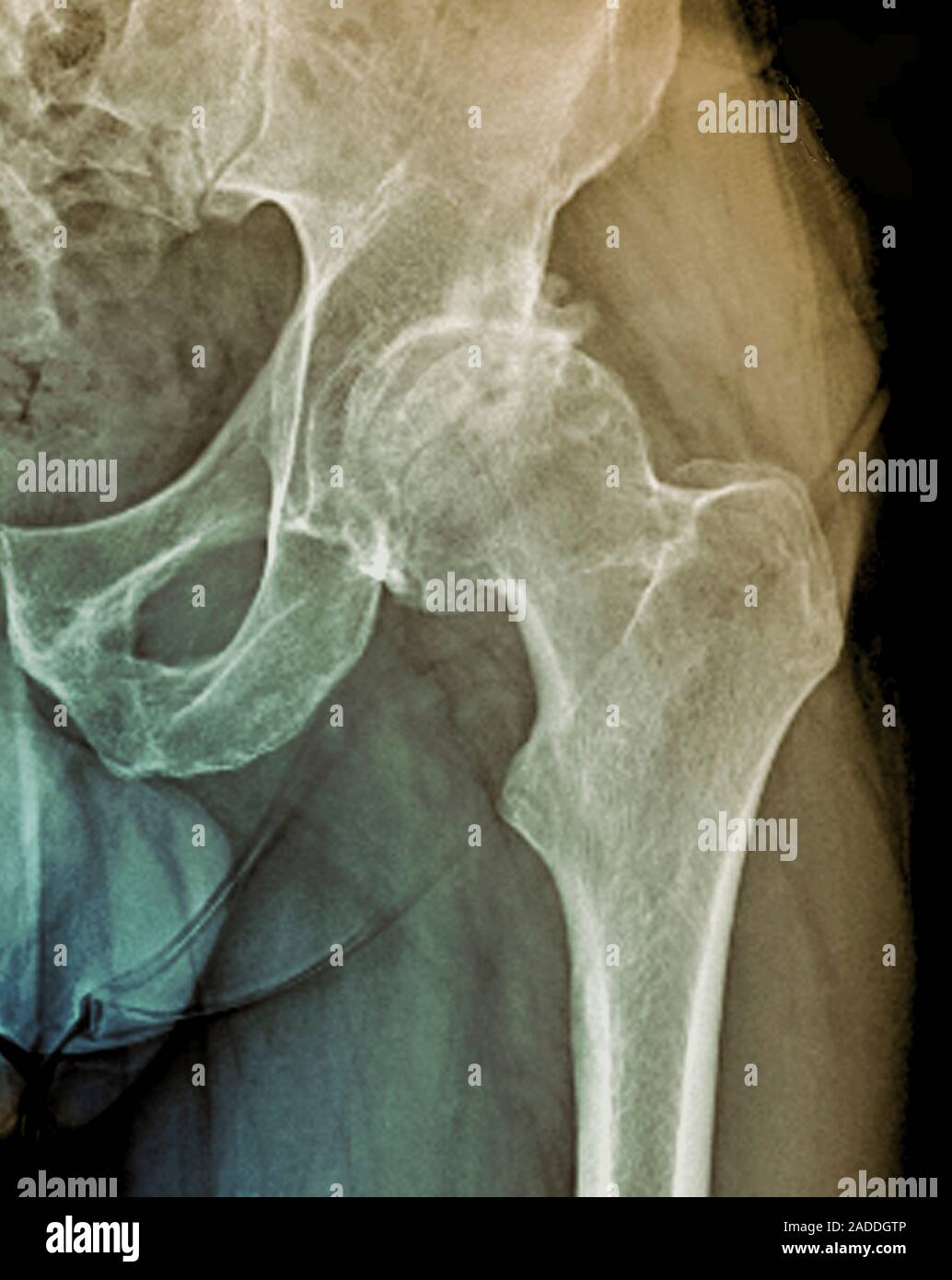 L ost on crose De La Hanche Frontal Couleur X ray De La Hanche Gauche l-ost-on-crose-de-la-hanche-frontal-couleur-x-ray-de-la-hanche-gauche