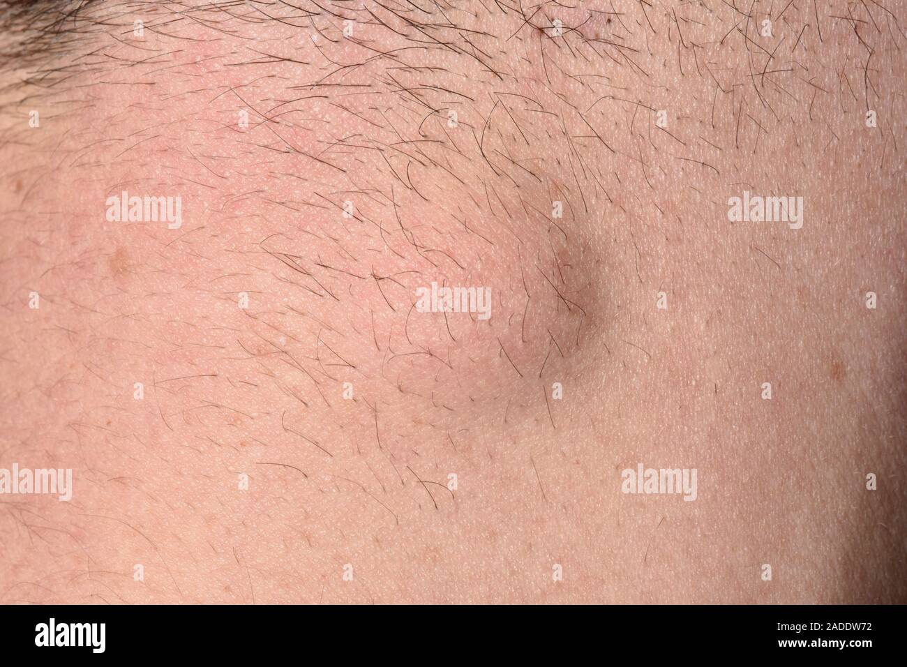 Kyste sébacé. Closeup d