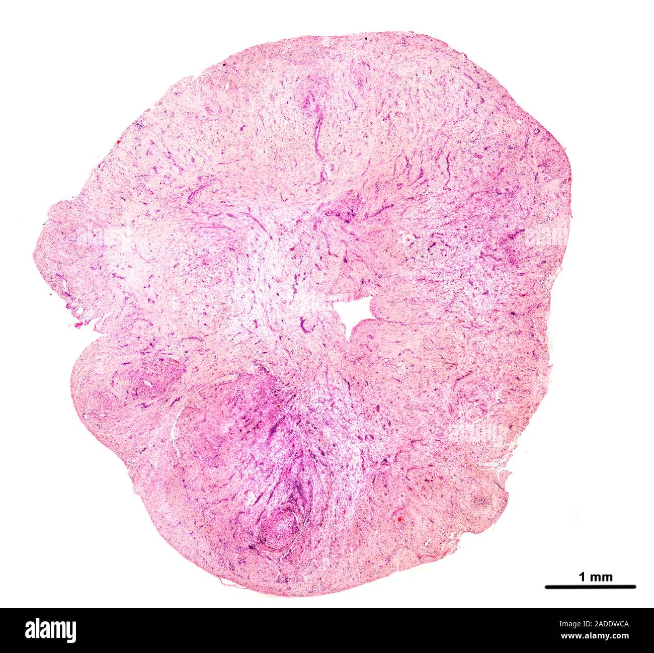 Schwannome, lumière microphotographie. Schwannomas sont bénignes tumeurs de la gaine du nerf dans le système nerveux périphérique qui résultent d'une prolifération des cellules de Schwann Banque D'Images