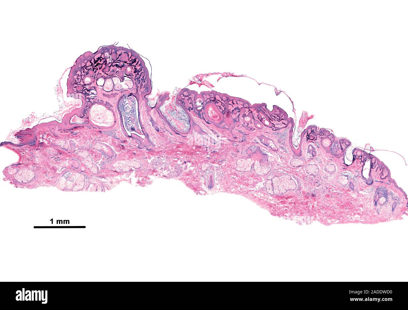 Kératose séborrhéique réticulée, lumière microphotographie. Kératose séborrhéique réticulée (kératose séborrhéique adénoïde) est la plus fréquente des sk non cancéreuses Banque D'Images