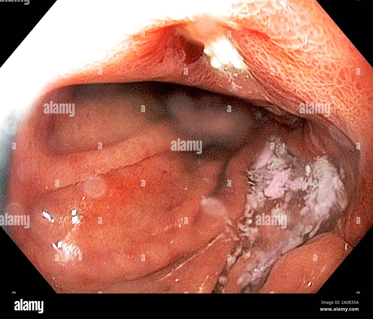 Cameron lésion. Vue endoscopique d'une lésion Cameron (blanc) dans la