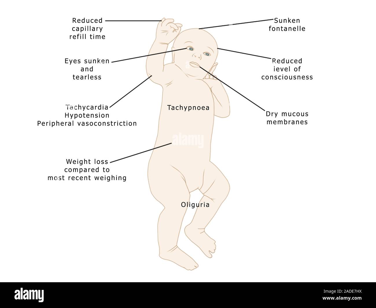 Les Symptomes De La Deshydratation Chez Les Bebes De L Illustration Les Symptomes Enumeres Ici Sunken Le Point Faible Sur Le Dessus De La Tete D Un Bebe Tachypn Photo Stock Alamy