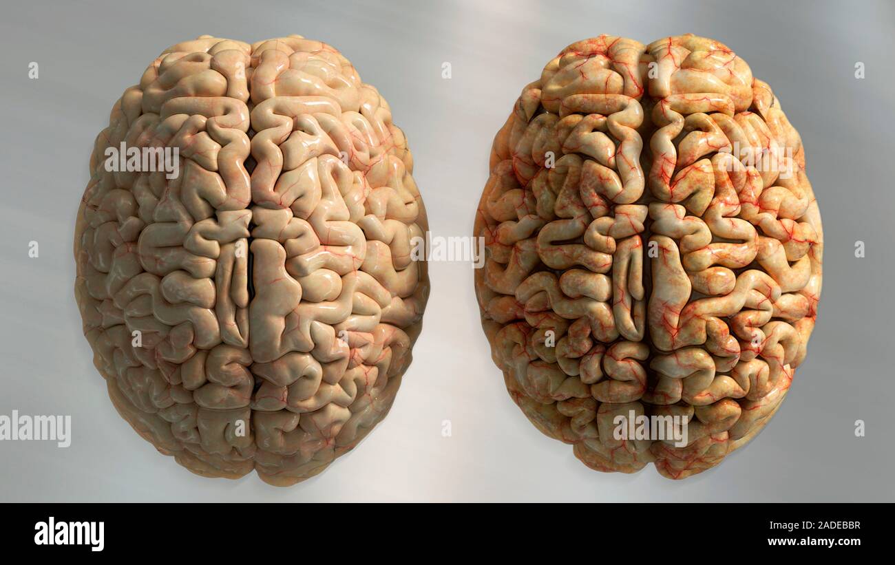 Cerveau en santé (à gauche) et du cerveau dans la maladie d'Alzheimer ...