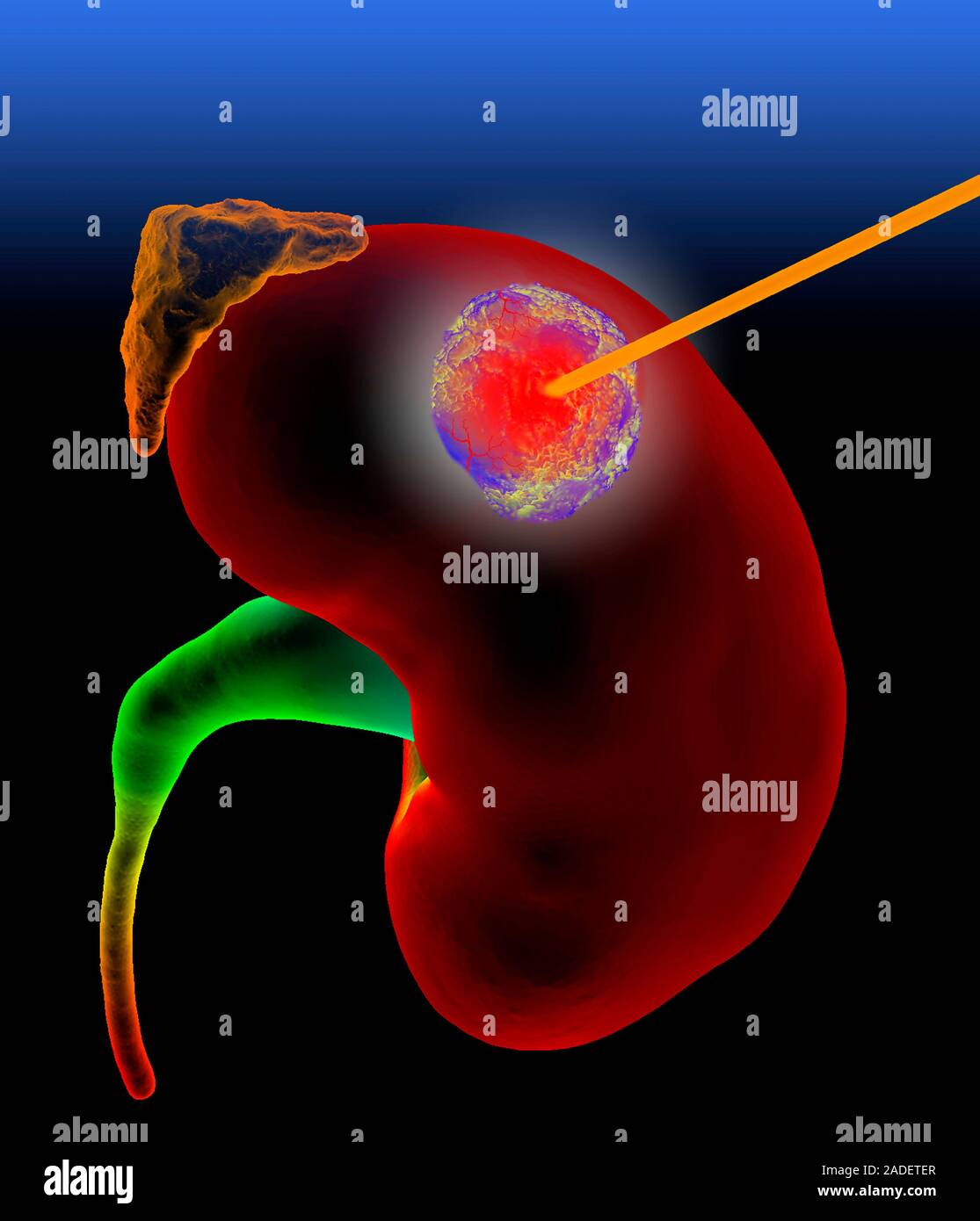 Ablation Du Rein Cancer _ Ablation Du Rein Durée De Vie WMCKD — free download