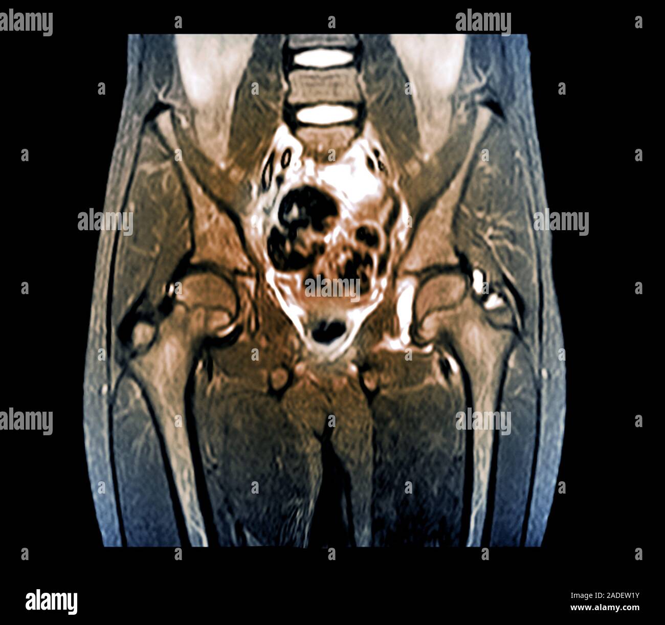 L'inflammation de la hanche. L'imagerie par résonance magnétique de couleur  (IRM) du bassin et des hanches d'un 10-year-old male patient avec une  douleur à la hanche gauche Photo Stock - Alamy