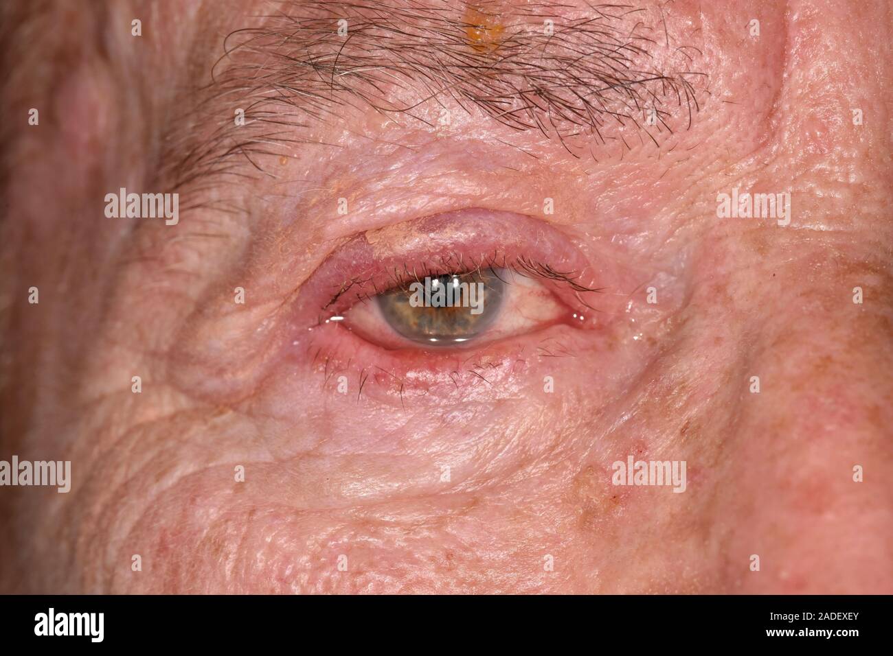 Parution du modèle. Zona éruption touchant nerf facial. Zona éruption, inflammation et