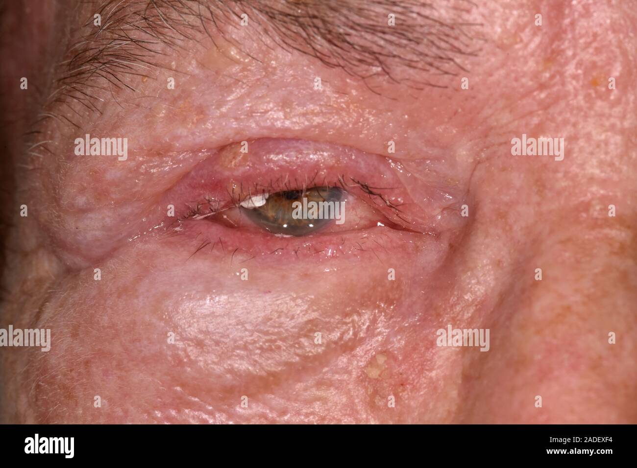 Parution du modèle. Zona éruption touchant nerf facial. Zona éruption, inflammation et