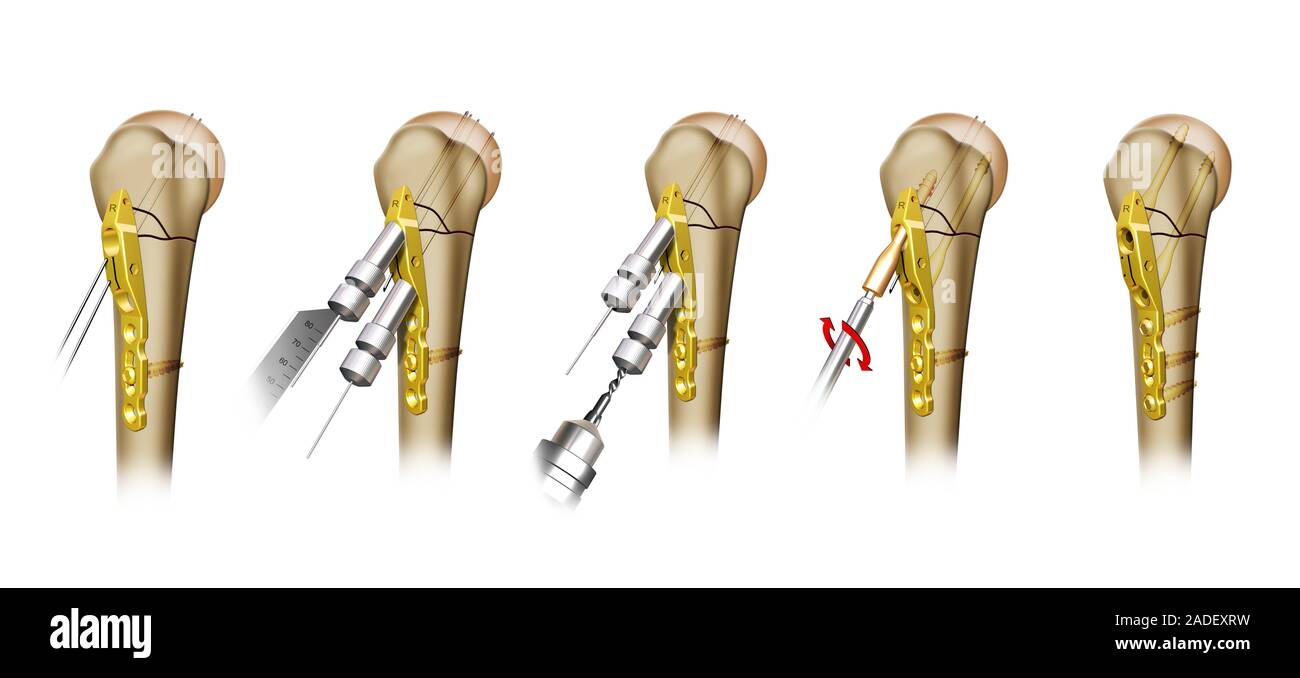 Chirurgie pour fracture de l'épaule, de l'illustration. De gauche, les  broches et les plaques et les vis sont en train d'être inséré dans  l'humérus (os du bras supérieur) de fixer une fract