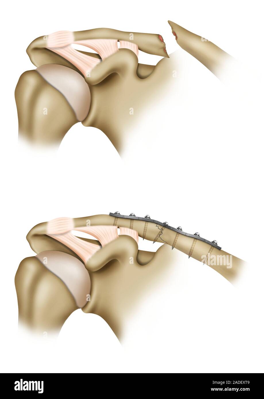 fracture-de-la-clavicule-la-chirurgie-de-r-paration-illustration