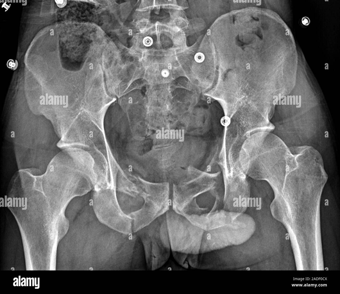 Fracture du bassin. X-ray du bassin de 23 ans, patient avec de ...