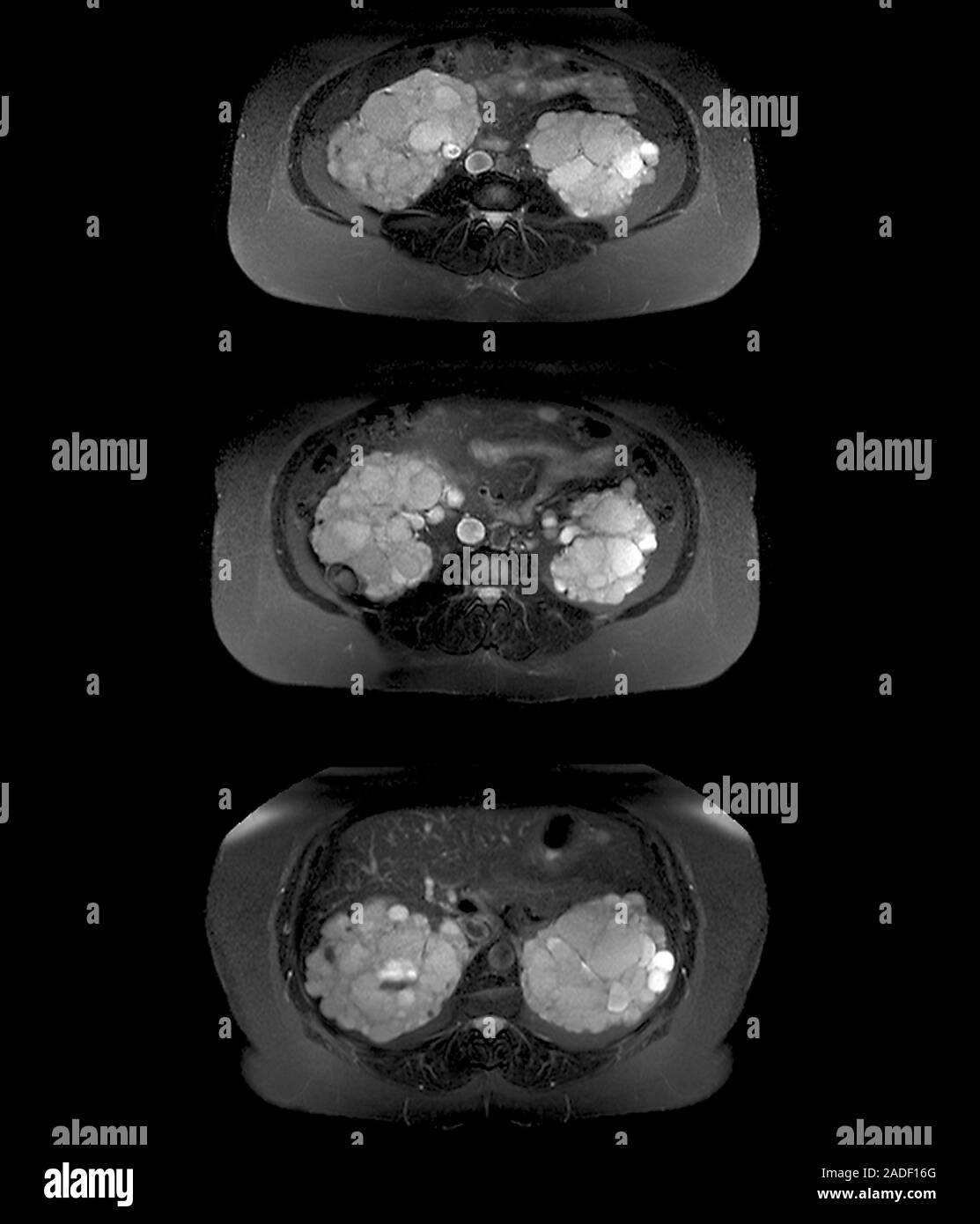 La maladie polykystique des reins. Jeu axial de l'imagerie par résonance magnétique (IRM) de l'abdomen d'une femme de 32 ans avec des reins polykystiques (gauche et droite) Banque D'Images