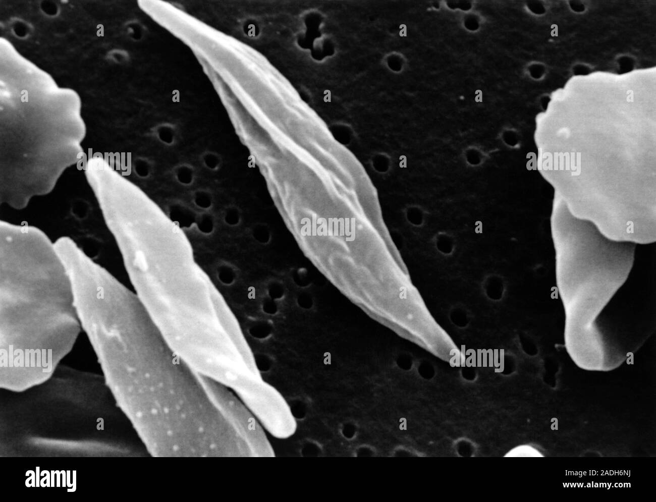 Micrographie électronique à balayage des globules rouges déformés dans ...