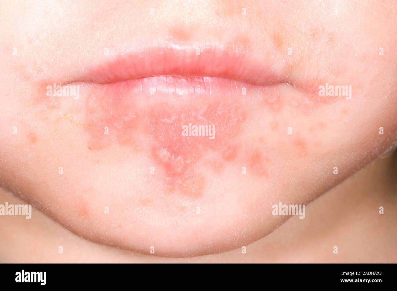 Muguet. La bouche et le menton d'un garçon de 2 ans avec la candidose  buccale (muguet, plaques rouges), une infection causée par le champignon  Candida albicans. C. al Photo Stock - Alamy