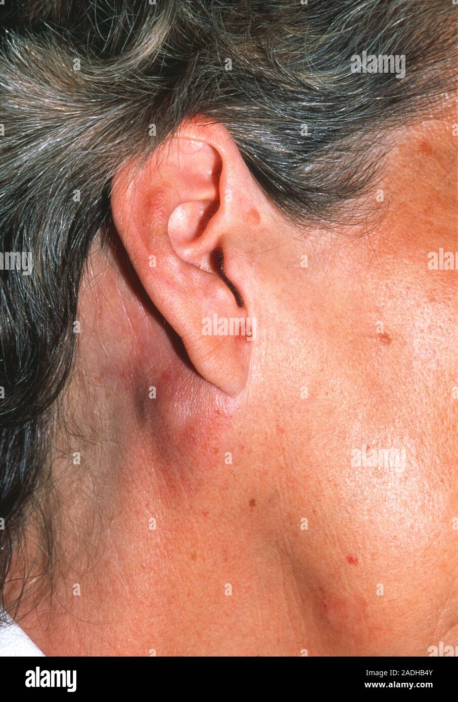 Le cancer lymphatique. Ganglions enflés (gonflement derrière l'oreille et  ci-dessous) dans le cou d'un 51-year-old femme souffrant de cancer  lymphatique (lymphome). Comme le pat Photo Stock - Alamy
