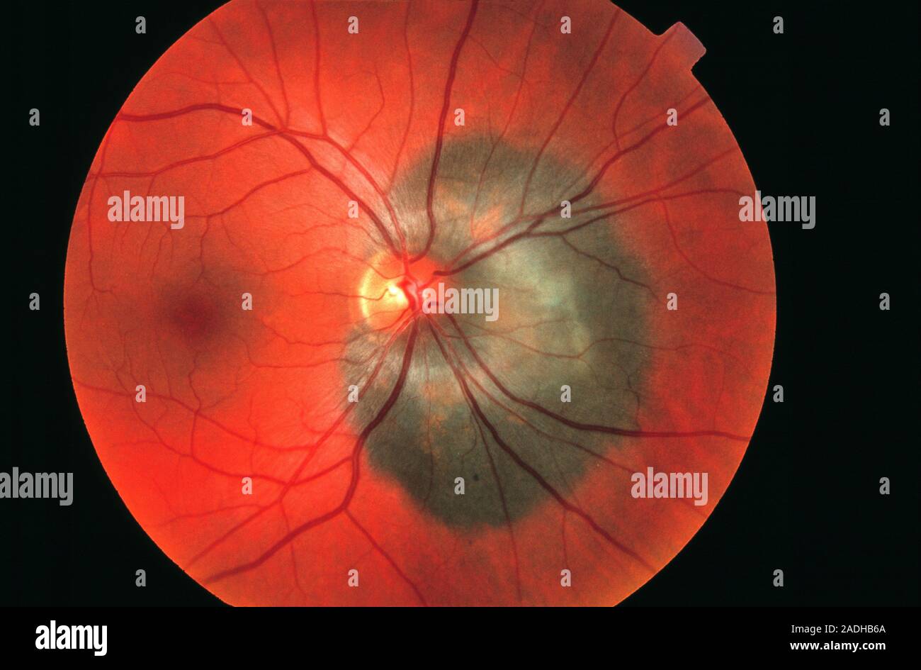 Les mélanomes malins. L'image de l'ophtalmoscope d'un mélanome malin ...