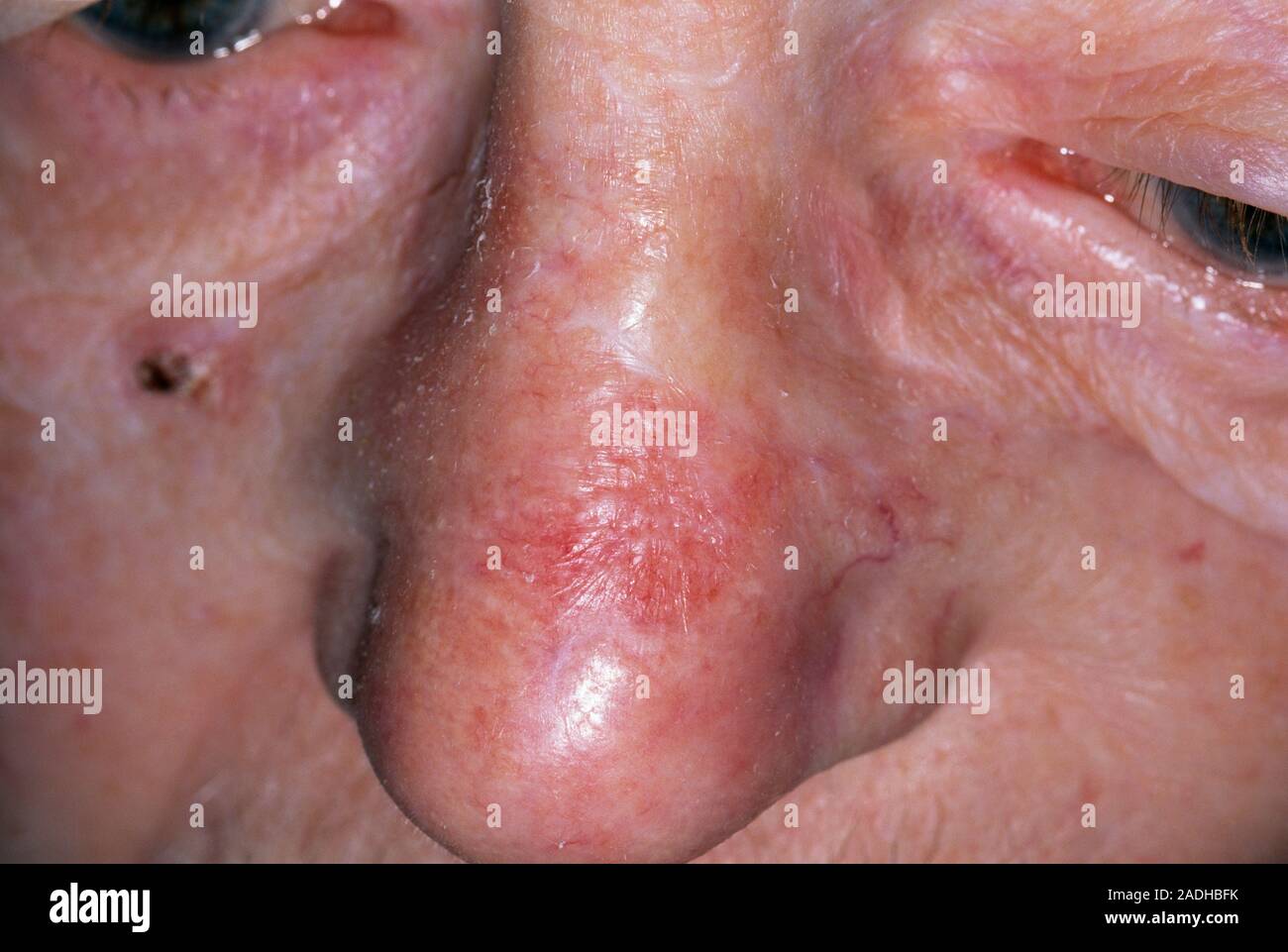 Cancer De La Peau Sur Le Nez Photo Cancer de la peau. La radiothérapie post-carcinome basocellulaire (CBC), ou  ulcus rodens, sur le pont du nez d'un 81-year-old man. C'est le plus  souvent le f Photo Stock - Alamy