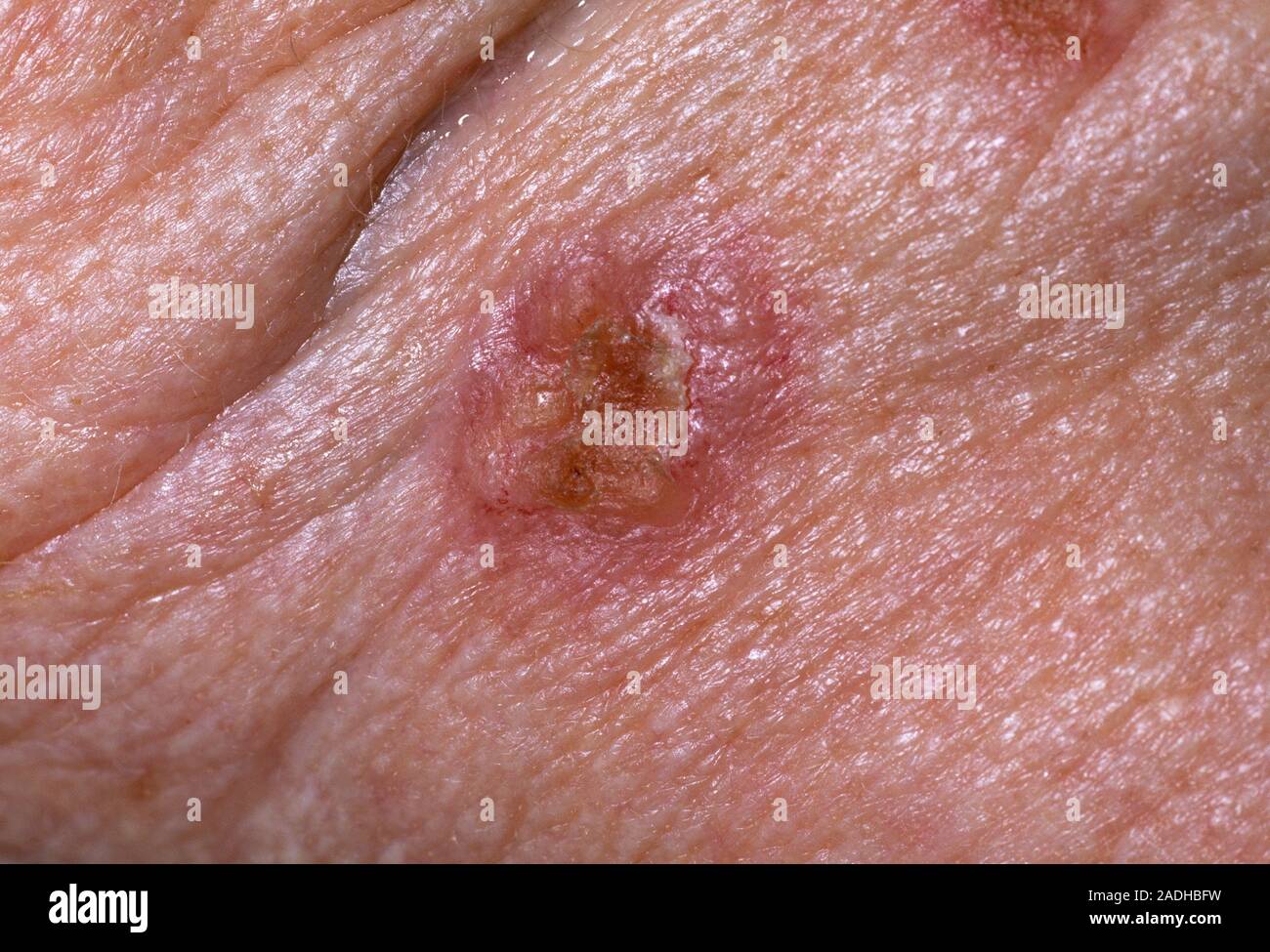 Ulcus Rodems Cancer de la peau. Le carcinome basocellulaire (CBC), ou ulcus rodens ...