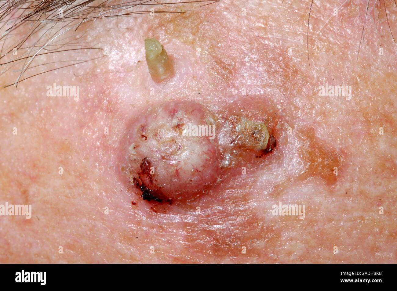Le carcinome basocellulaire (CBC) cancer de la peau sur le cuir chevelu d'un homme âgé de 75 ans