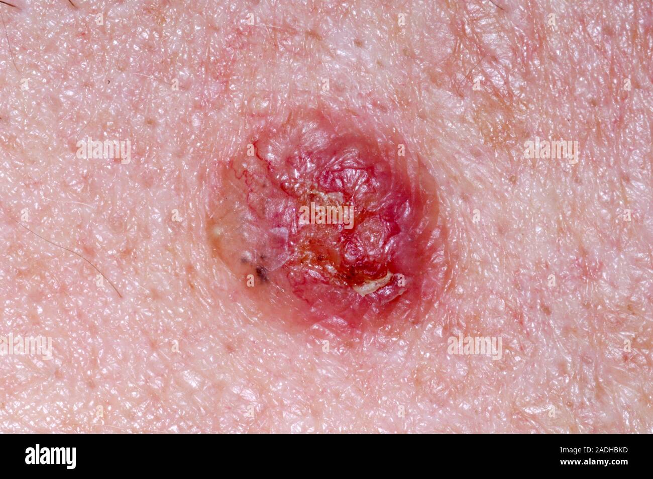 Ulcus Rodems Cancer de la peau. Le carcinome basocellulaire (CBC), ou ulcus rodens ...