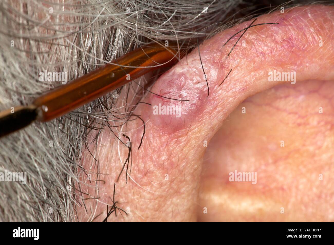 Parution du modèle. Le carcinome basocellulaire (CBC), ou ulcus rodens, sur  une oreille externe du patient (pinna). C'est la forme la plus courante de  cancer de la peau chez les juste Photo