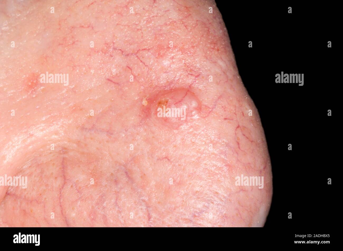 Ulcus Rodems Le carcinome basocellulaire (CBC), ou ulcus rodens, sur un 98 ans ...