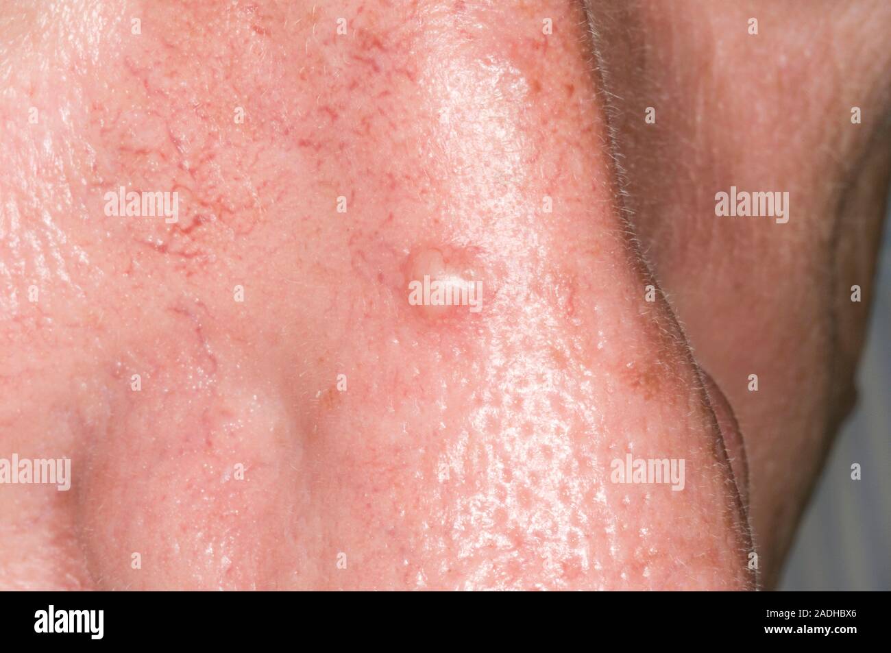 Cancer De La Peau Sur Le Nez Photo Le carcinome basocellulaire (CBC), ou ulcus rodens, sur un homme de 52 ans  son nez. C'est la forme la plus courante de cancer de la peau chez les  personnes à peau claire.