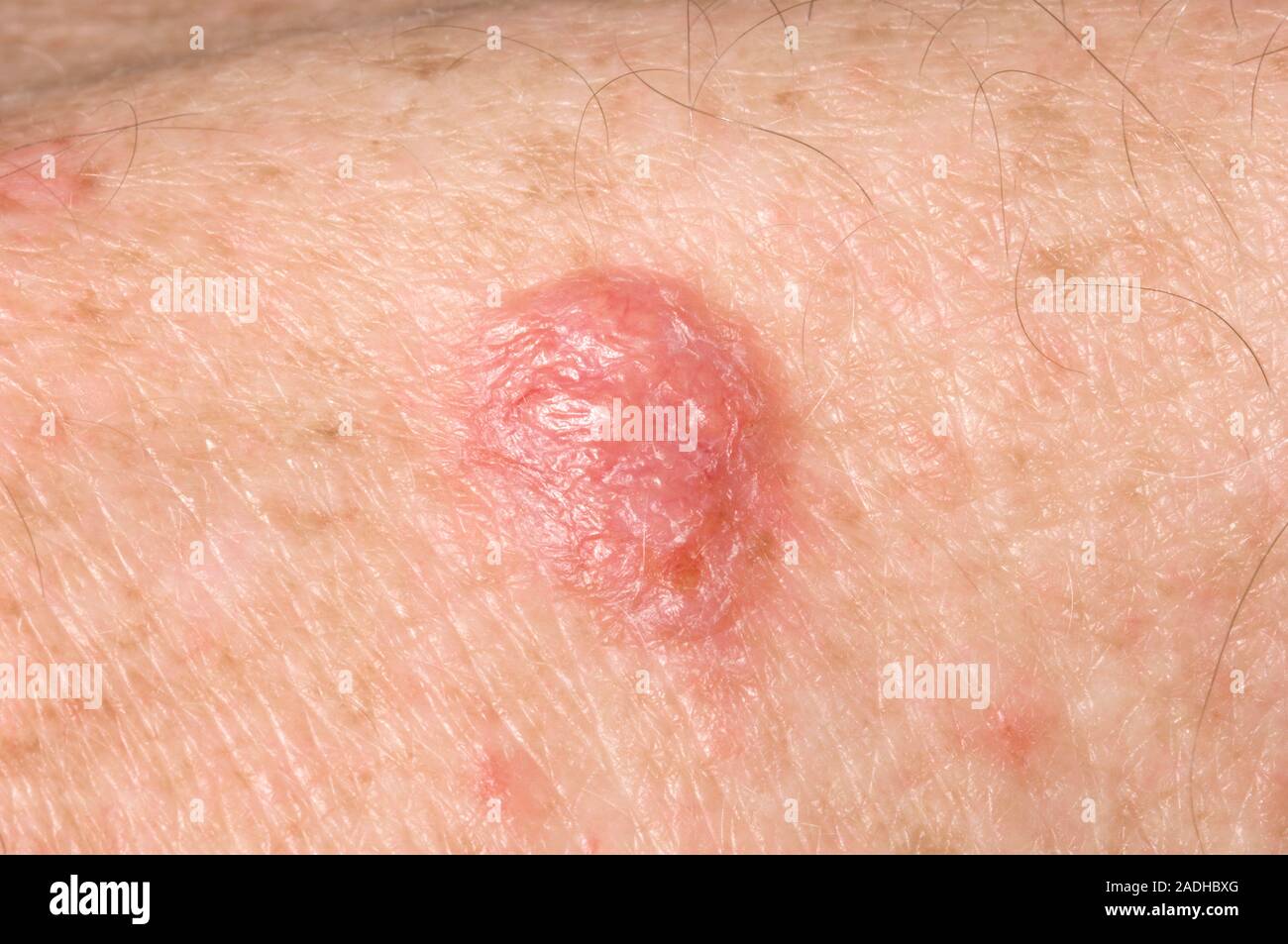 Le carcinome basocellulaire (CBC), ou ulcus rodens, sur un homme de 61 ans l