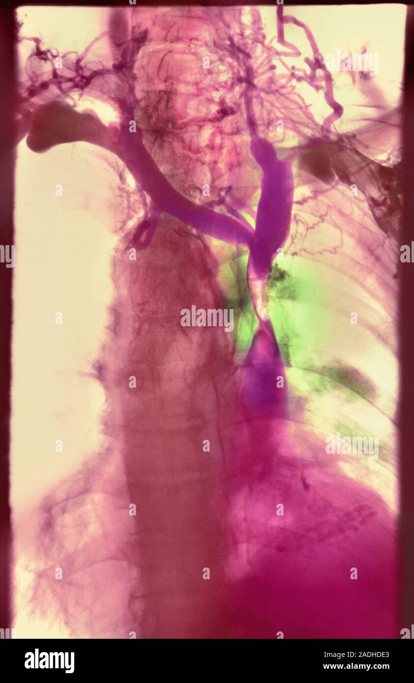 Le cancer du poumon. Poitrine de couleur Xray montrant un — free download