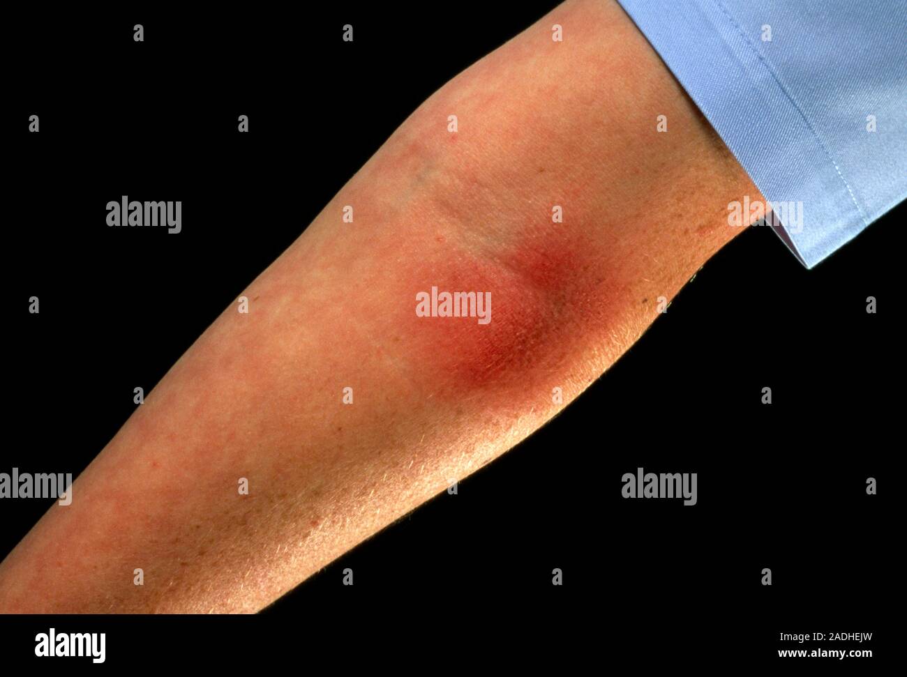 L'eczéma sur les bras. Close-up de l'eczéma dans le creux du coude. La peau  est rouge et gonflée. L'eczéma est une inflammation de la peau, accompagnée  d'itchin Photo Stock - Alamy