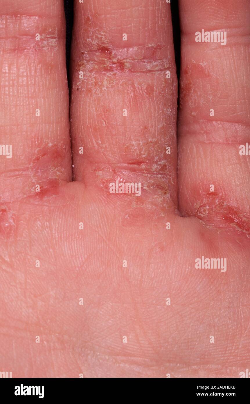 L'eczéma sur les doigts d'une jeune fille de 15 ans. L'eczéma est un ...