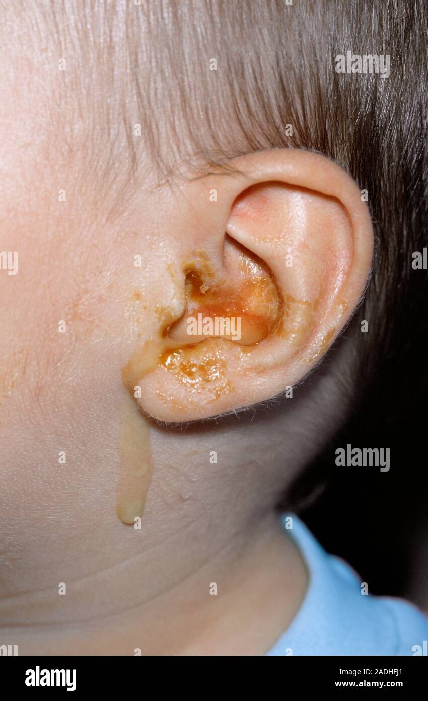 Otitis media l'infection. Close-up de pus (jaune) dans l'oreille d'un de  cinq mois avec un garçon de l'otite moyenne sécrétoire. Il s'agit d'une  accumulation chronique de la grippe Photo Stock - Alamy