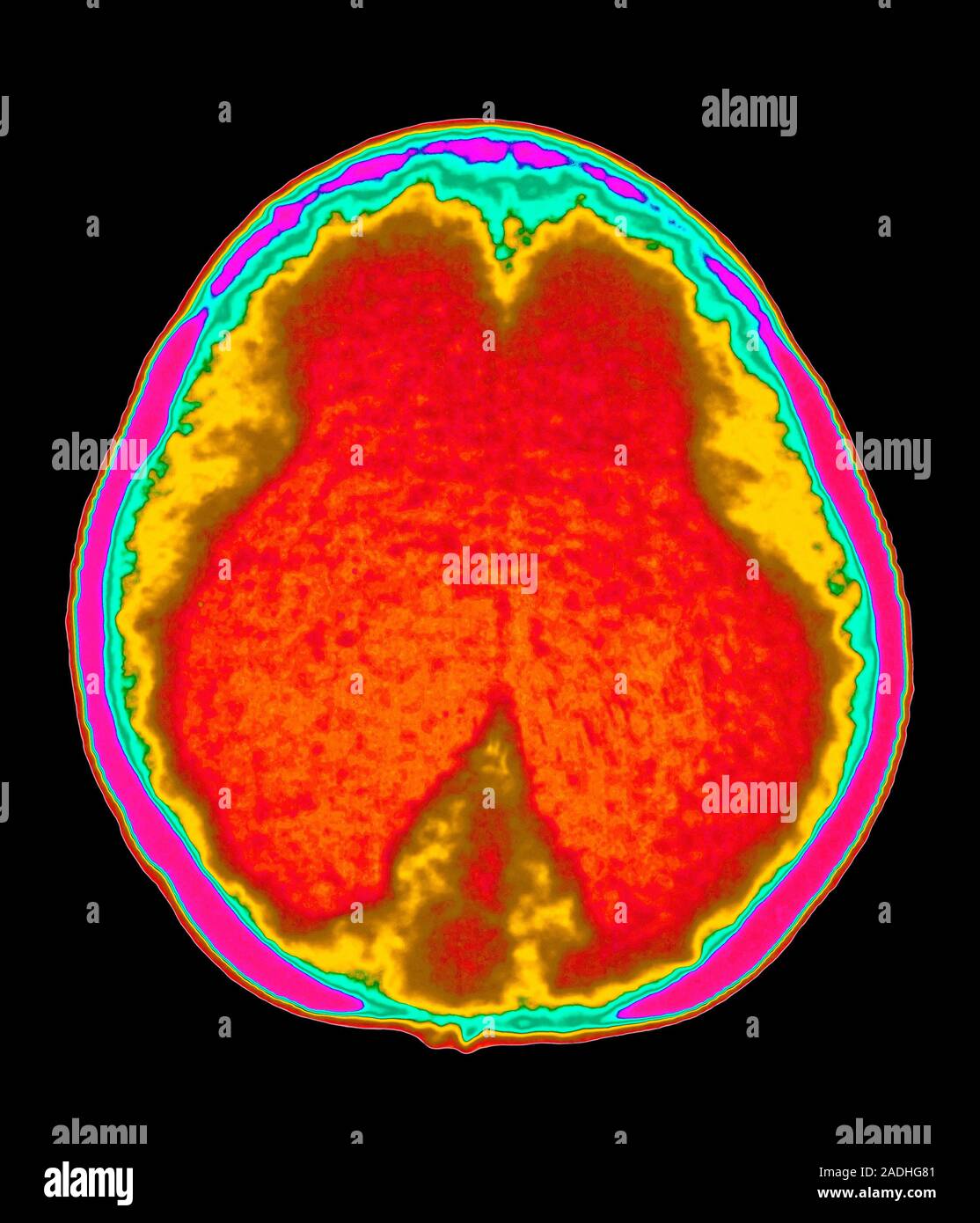 L'hydrocéphalie. Couleur scanner de d'un jeu axial (horizontal) section à travers le cerveau d'un enfant atteint d'hydrocéphalie (de l'eau sur le b Banque D'Images
