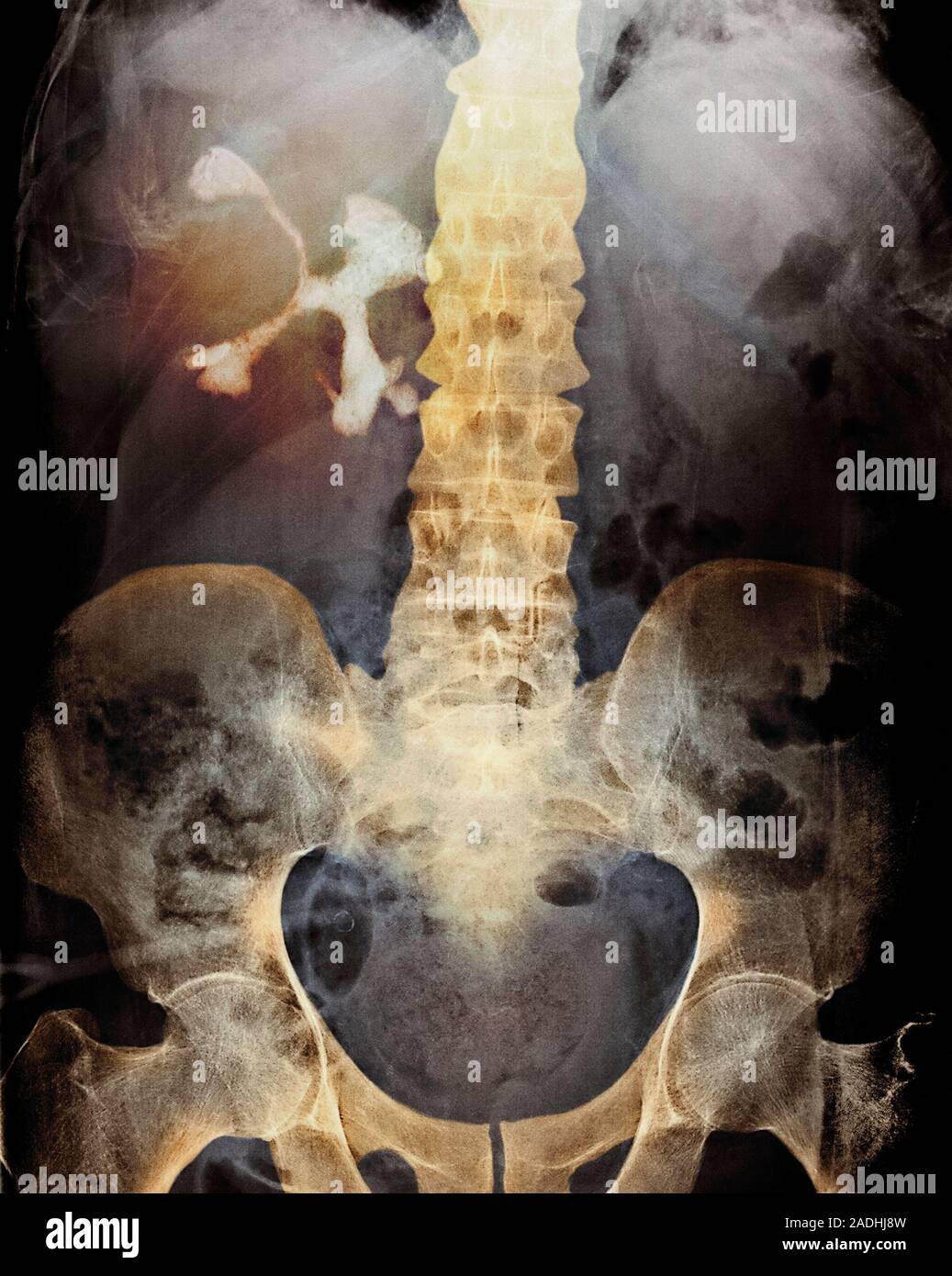 Staghorn calcul rénal. X-ray de couleur de l'abdomen d'un patient avec une  grande pierre staghorn (blanc, en haut à gauche) dans le rein droit.  Pierres de rein un Photo Stock - Alamy