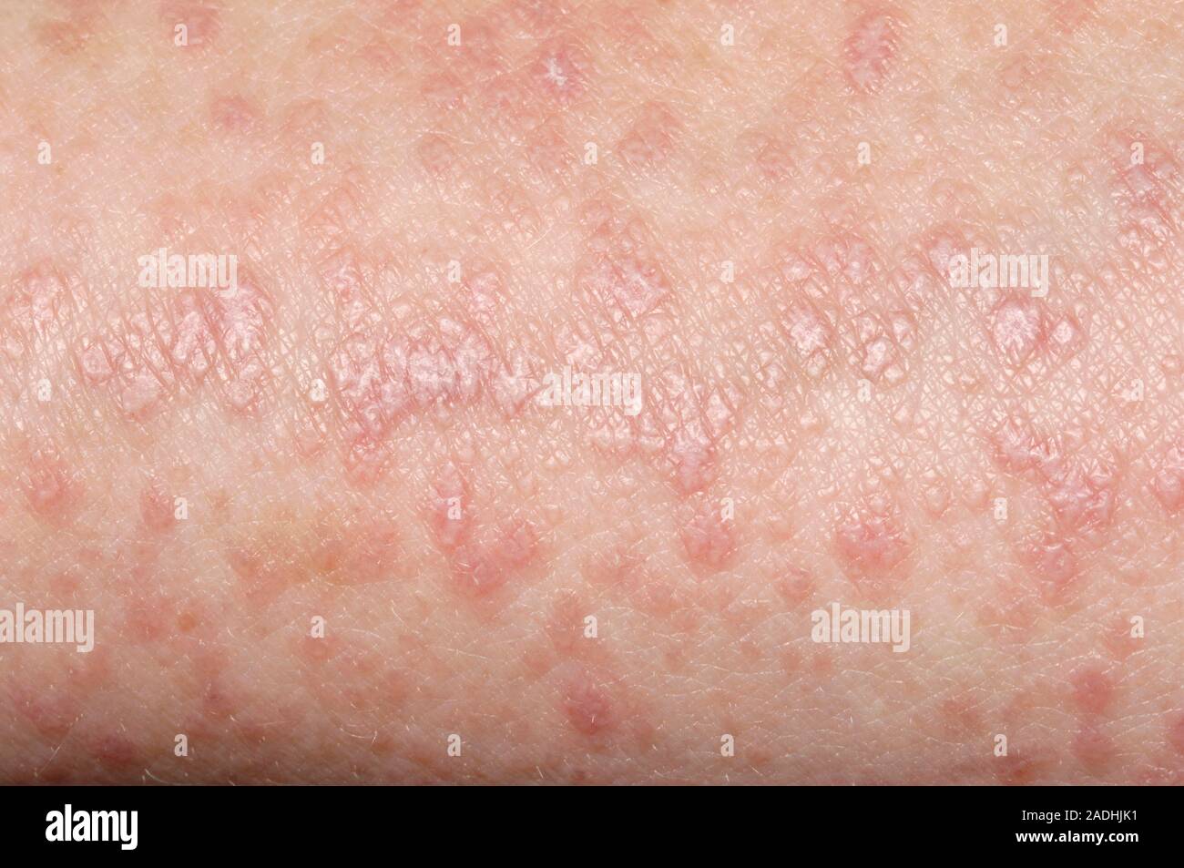 Le planus de lichen de la maladie. Close-up de la peau d'une femme ...