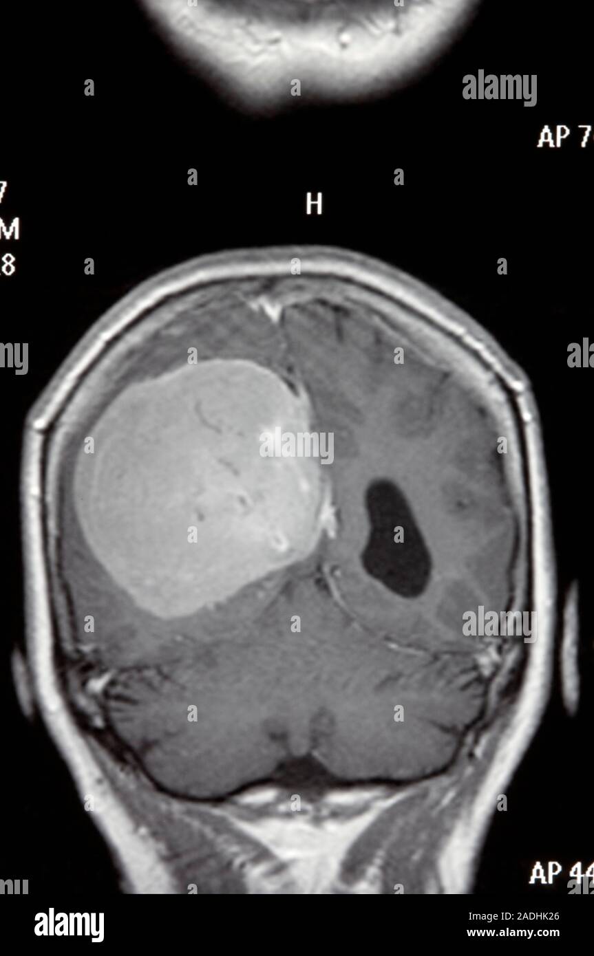 M ningiome Tumeur Au Cerveau L imagerie Par R sonance Magn tique IRM 