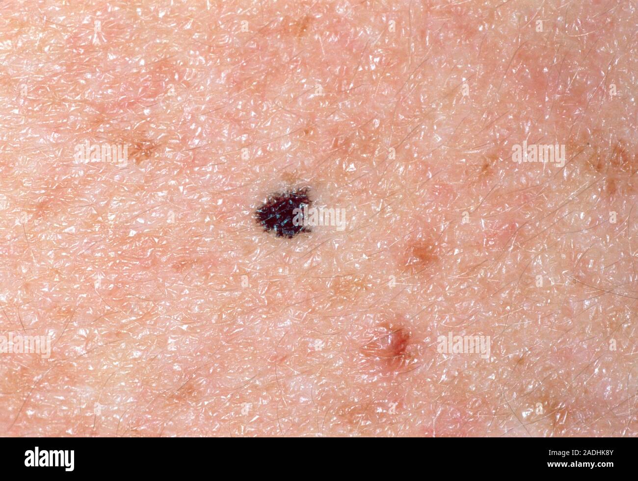 Mole bénigne. Naevus mélanocytaires (peinture), également connu sous le nom de mole, sur la peau d'un homme âgé de 18 ans. Les taupes sont des excroissances bénignes au brun foncé, bro Banque D'Images