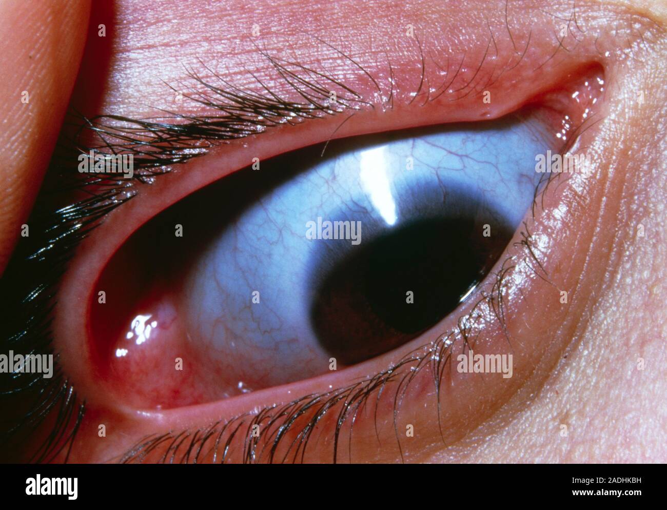 Close-up de l'œil bleu montrant une sclère, les RUP, normalement manteau  blanc de l'œil. C'est un symptôme caractéristique de l'ostéogenèse imperfe  Photo Stock - Alamy
