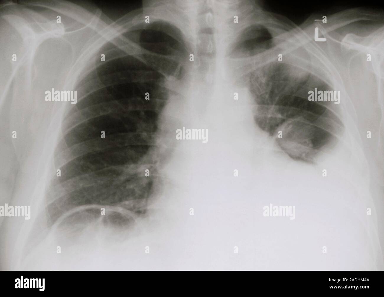 Radiographie montrant un épanchement pleural, une introduction de ...
