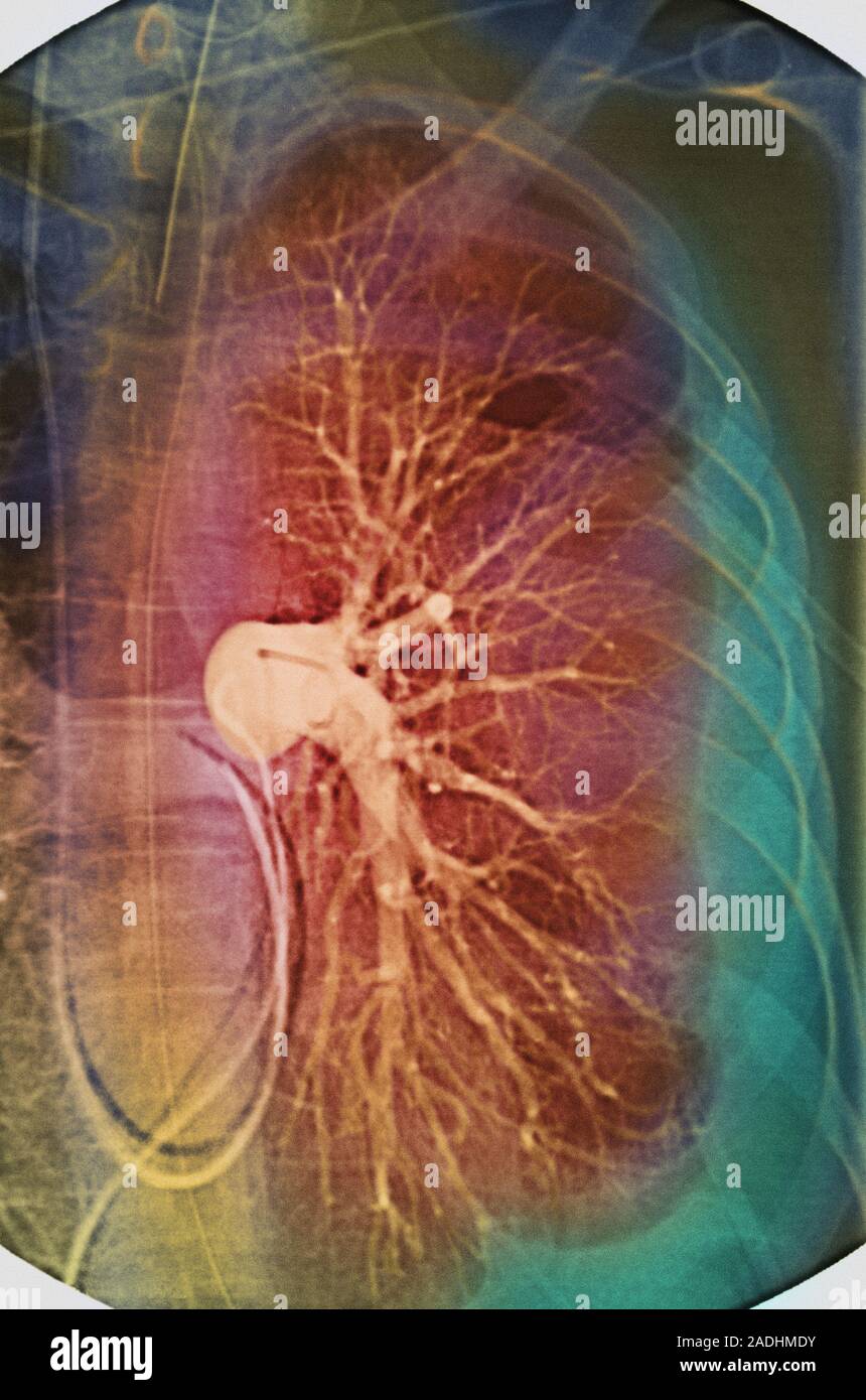 L'épanchement pleural. X-ray de couleur des vaisseaux sanguins ...